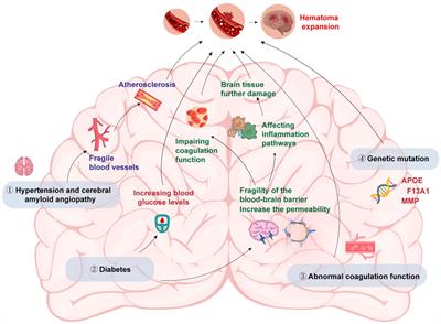 Research advances in imaging markers for predicting hematoma expansion in intracerebral hemorrhage: a narrative review